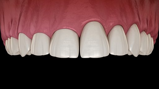 Illustration of a mouth with an uneven gumline