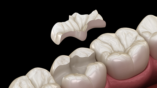 Illustration of an inlay being placed in a broken tooth