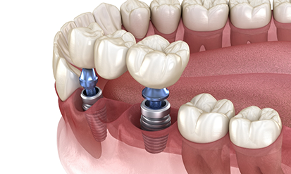 Illustration of two dental implants and a dental bridge replacing three missing teeth