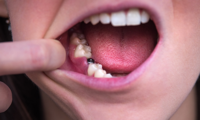 Close up of a mouth with a visible abutment piece where a tooth is missing