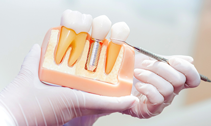 Dentist showing a model of a dental implant in the jaw to a patient