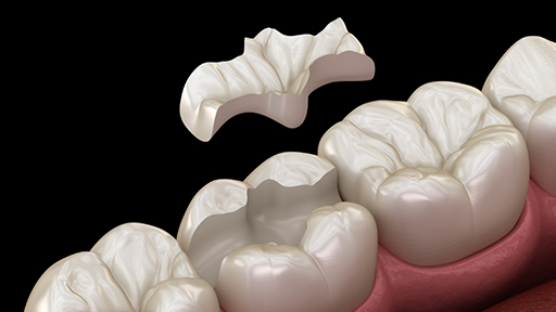Illustration of an inlay restoring a chipped tooth