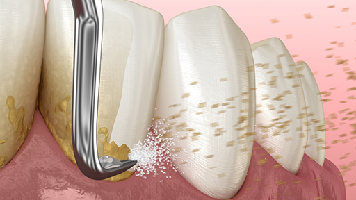 Illustration of a dental scaler clearing tartar buildup from the teeth and gums