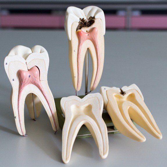 Model healthy tooth and tooth in need of root canal treatment