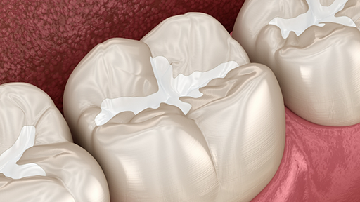 Illustrated tooth with a white filling