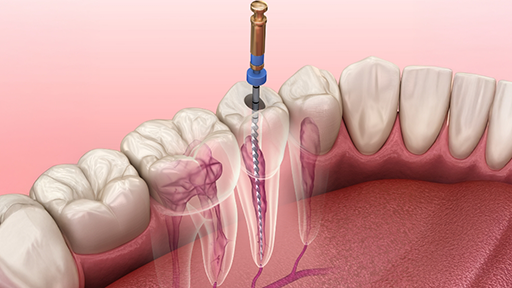 Illustration of a tooth getting root canal treatment
