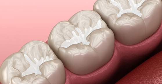 a 3D example of tooth-colored fillings
