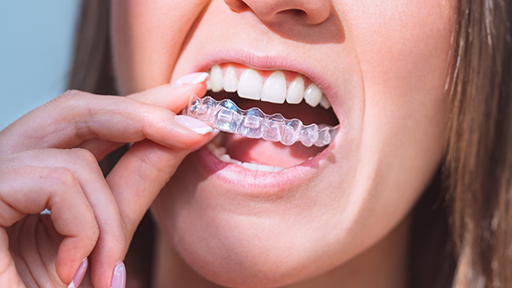 Woman placing an Invisalign aligner over her teeth