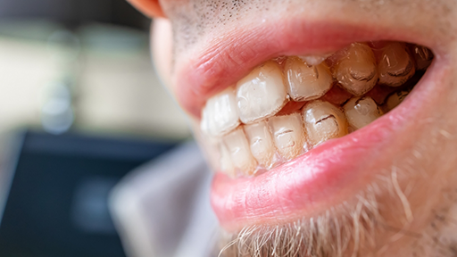 Close up of a man with clear aligners over his teeth