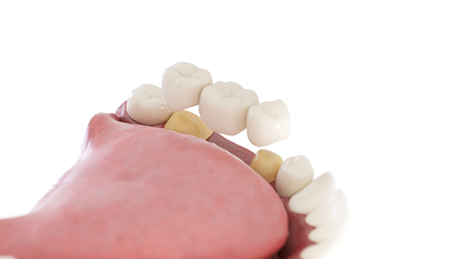 Model of a dental bridge replacing a missing tooth