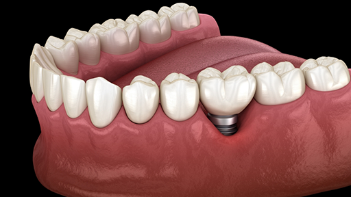 Illustration of a dental implant with a crown replacing a missing tooth