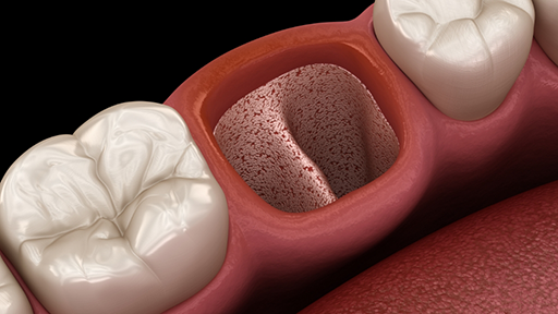 Illustration of an empty socket in the mouth after a tooth extraction